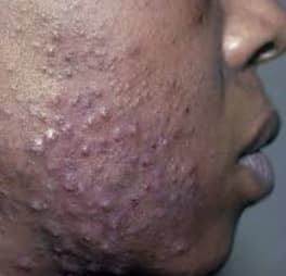 Hormonal Skincare Support